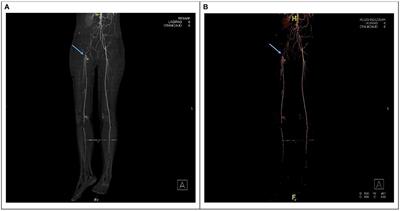 Case report: Restrictive cardiomyopathy presenting with complete thromboembolism occlusion of the terminal part of the abdominal aorta in a preadolescent Saudi girl